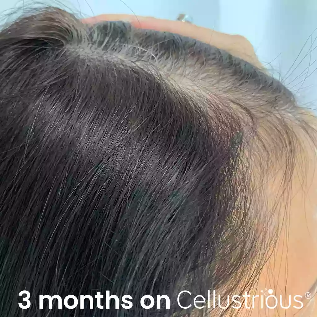 Cellustrious patient after treatment