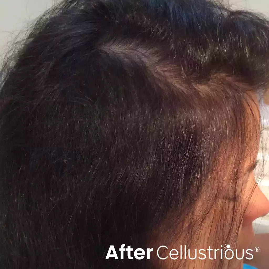 Cellustrious patient after treatment