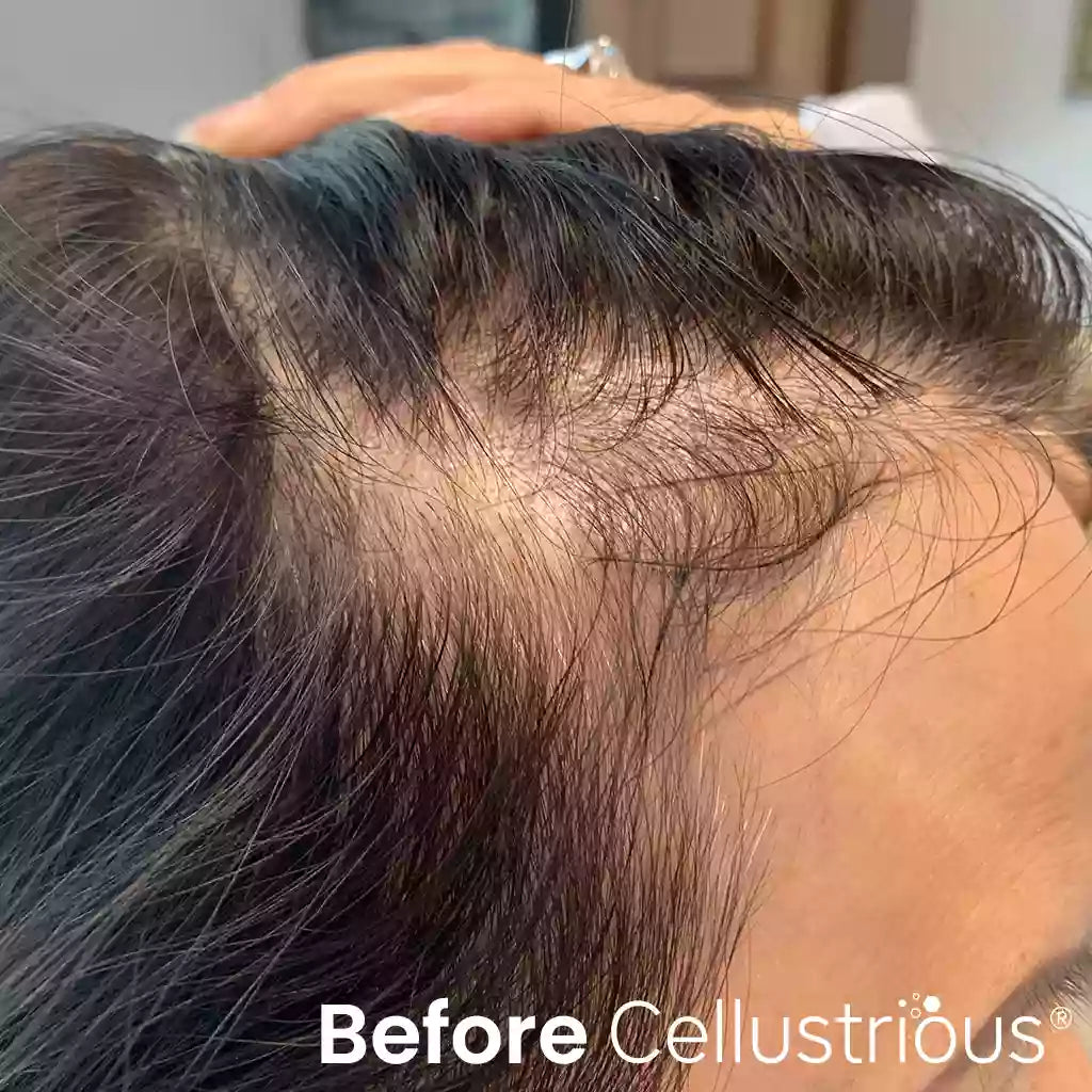 Cellustrious patient before treatment