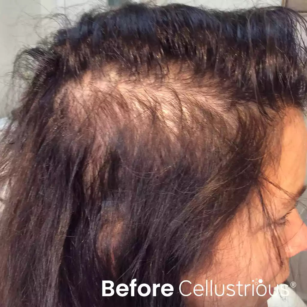 Cellustrious patient before treatment
