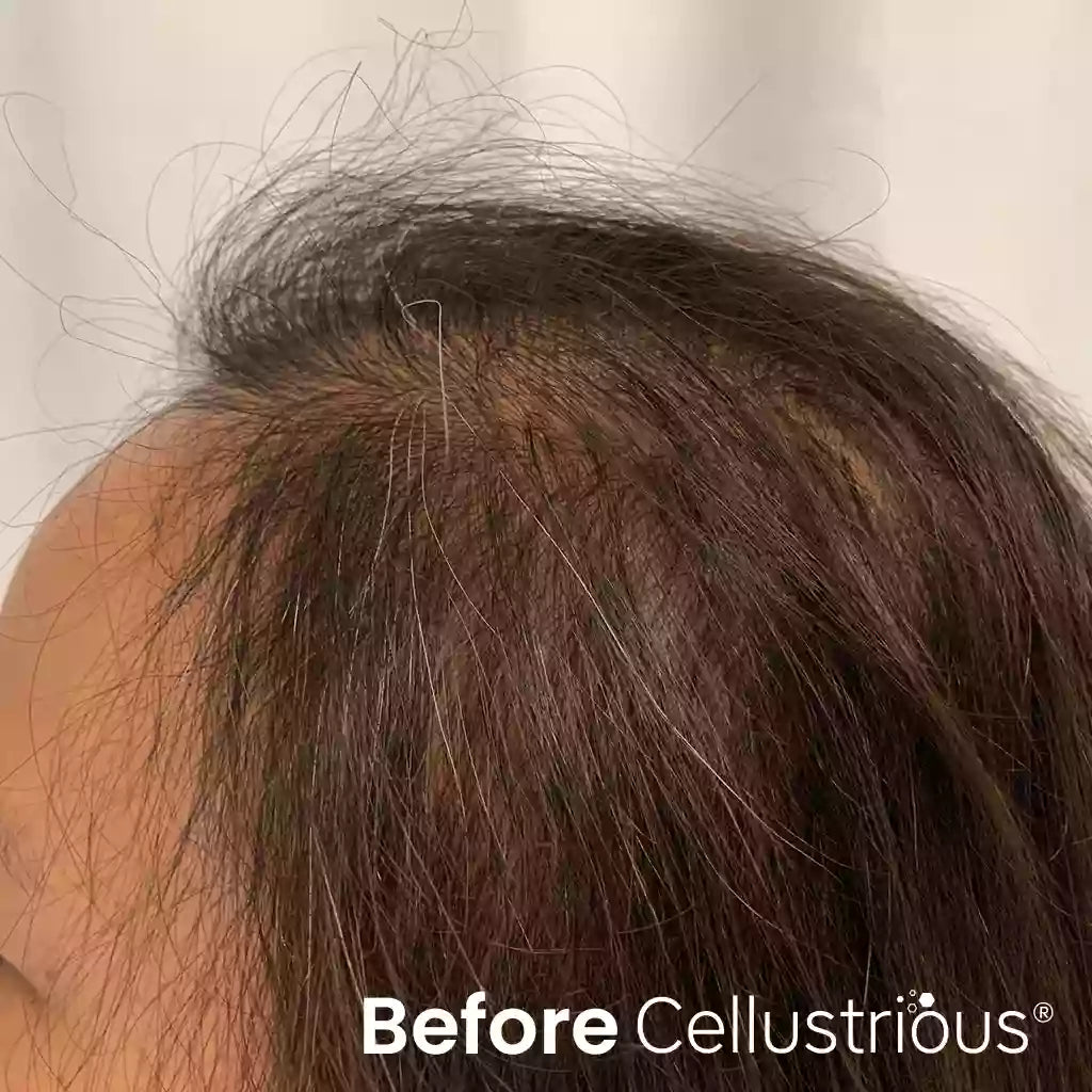 Cellustrious patient before treatment