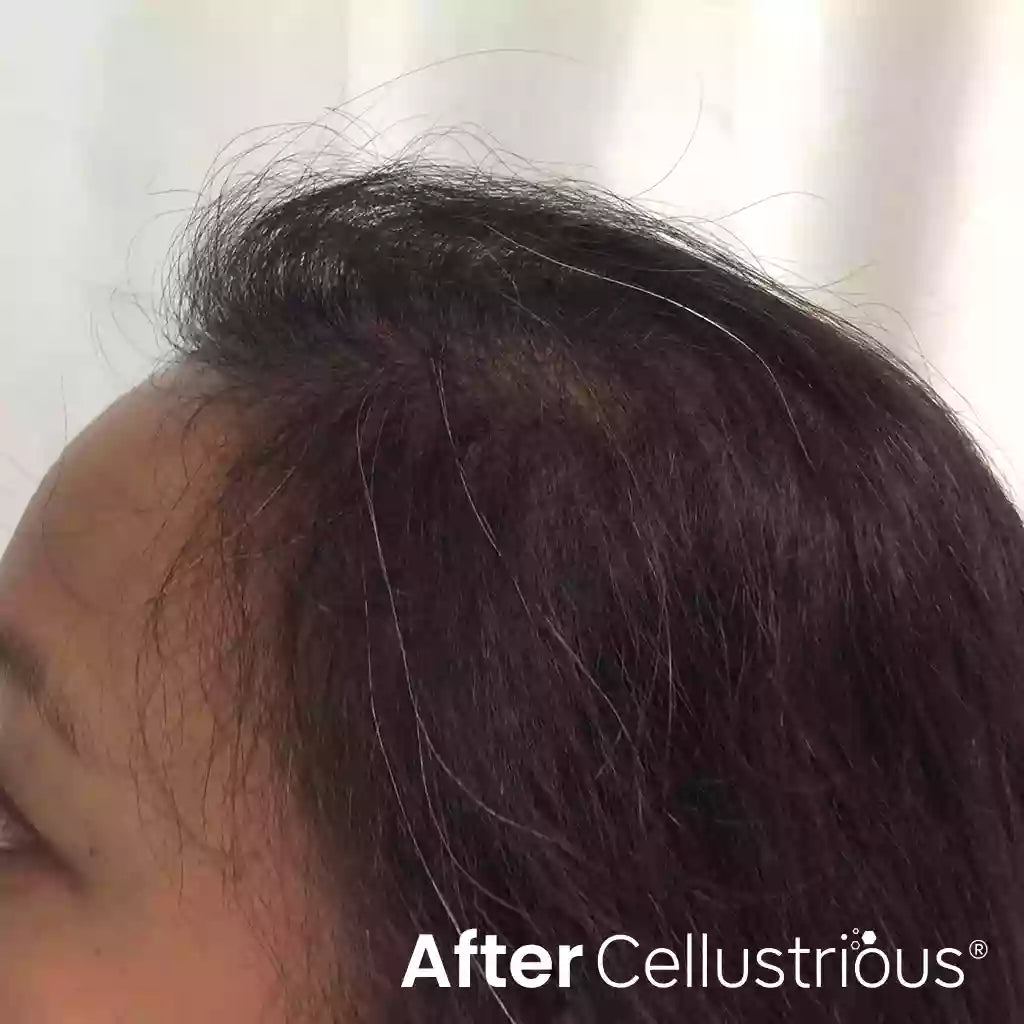 Cellustrious patient after treatment