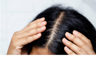 hair loss Cellustrious folliculitis