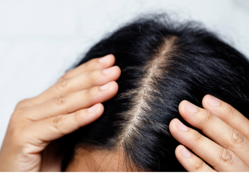 Hair Loss: Can Folliculitis be the Cause?