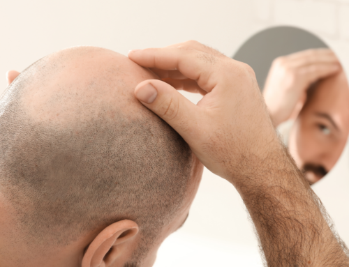 4 COMMON MYTHS ABOUT MALE PATTERN HAIR LOSS