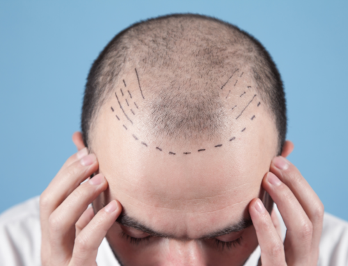 5 Reasons Not to Get a Hair Transplant
