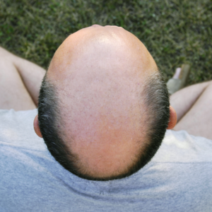 Cellustrious-Men-with balding scalps may be at risk for heart attacks and calcification 