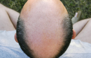 Cellustrious-Men-with balding scalps may be at risk for heart attacks and calcification