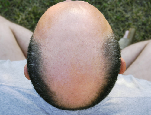 Is There a Link Between Heart Attacks and Hair Loss?